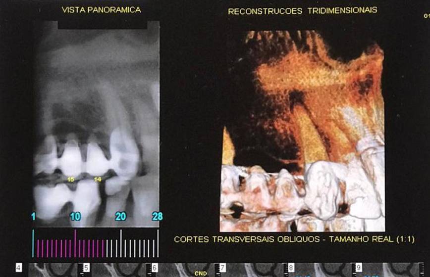 Importância da realização de exames de radiografia e tomografia antes da instalação de implantes